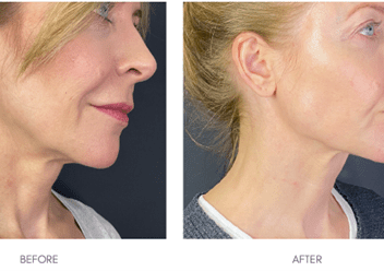 Profhilo face & neck