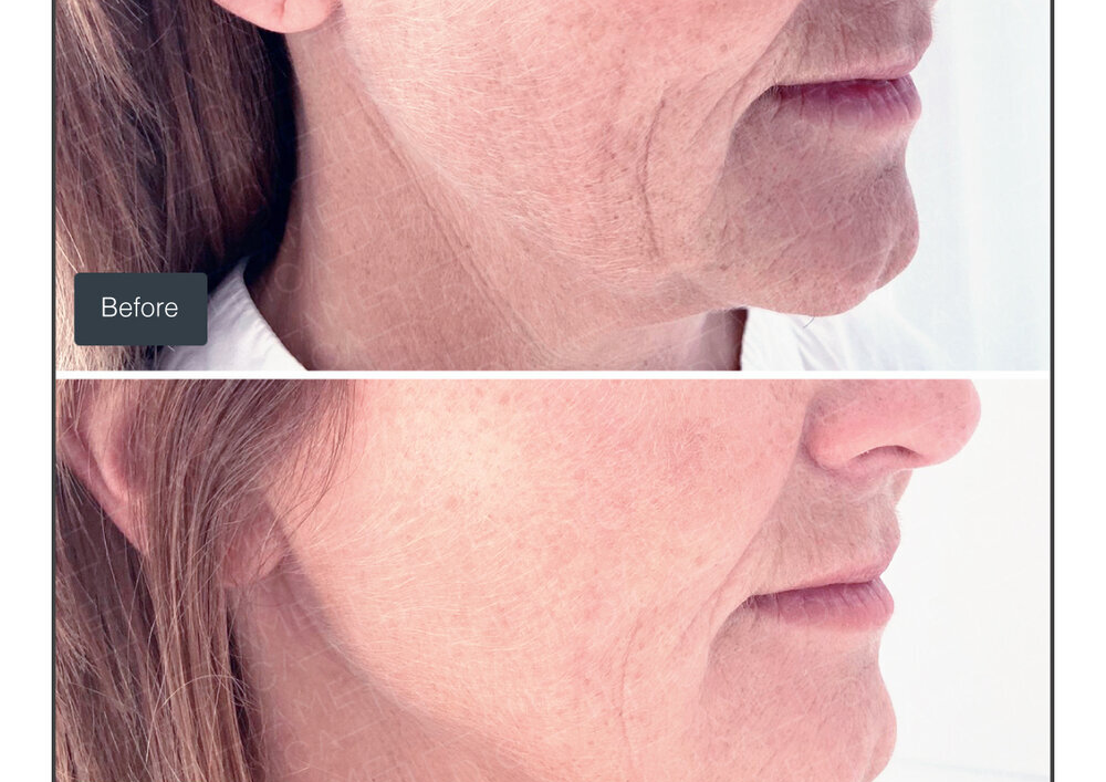 Vitaran Eyes Polynucleotides X 3 Sessions ⭐️SAVINGS £45!! 