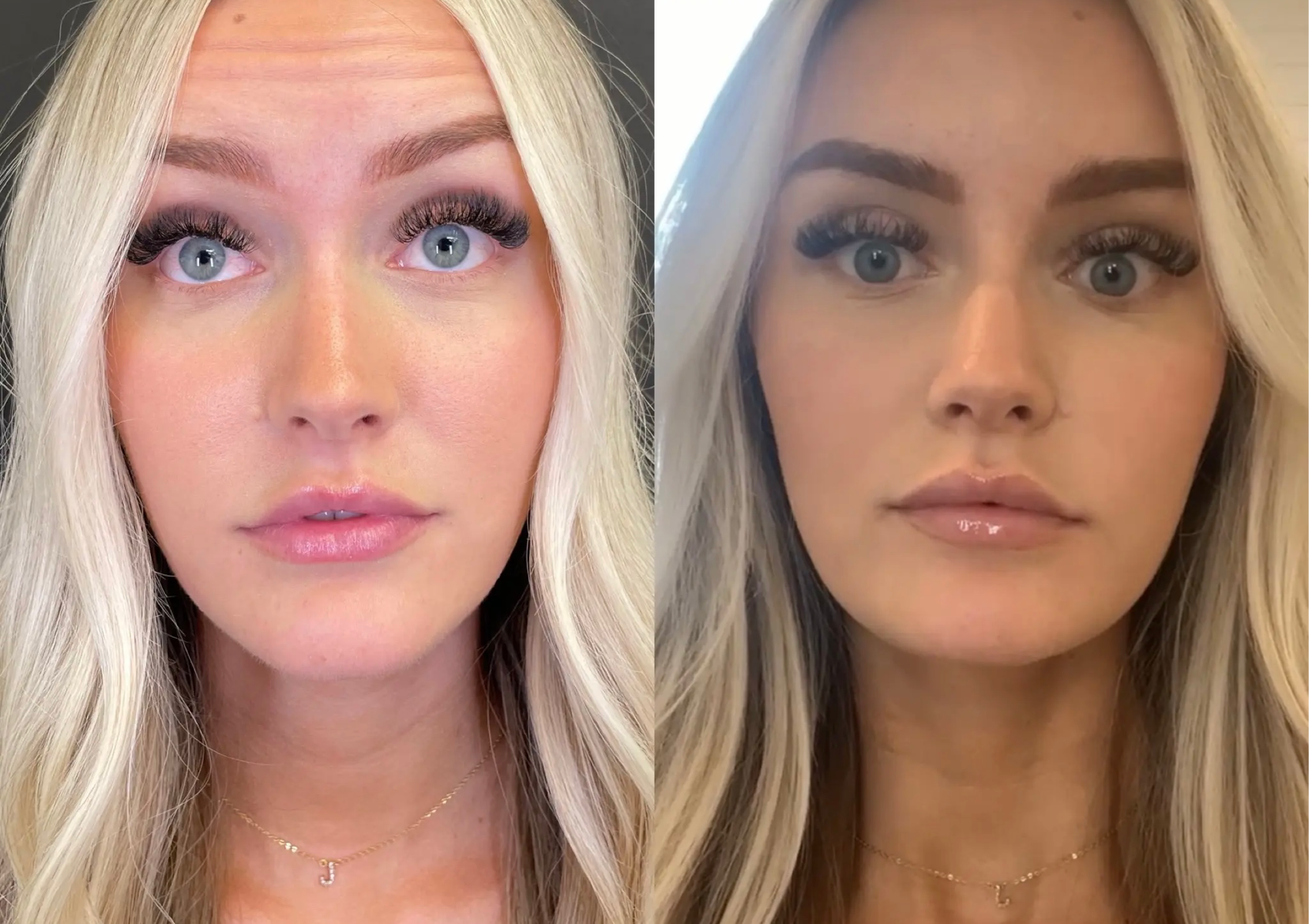 Ladies x  3 Botox Areas 