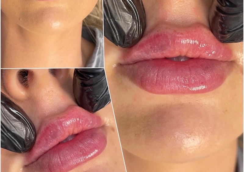 2 ml Lip filler 