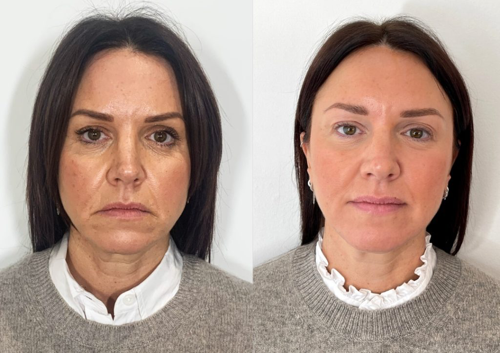 Lift that Turned down smile 