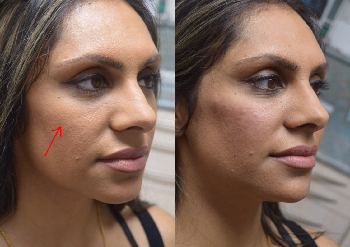 2ml cheek filler 