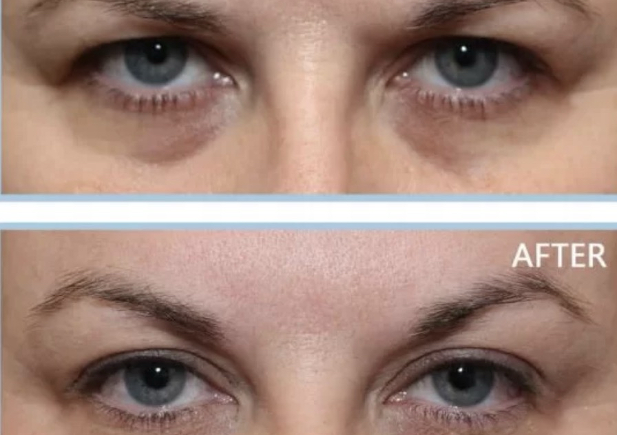 Eye Brow Lift 