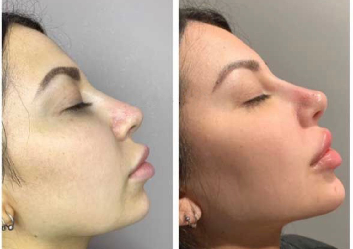 1ml Chin filler 