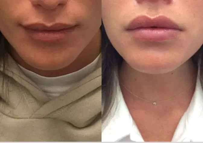 Lip flip enhance that top lip ❌filler