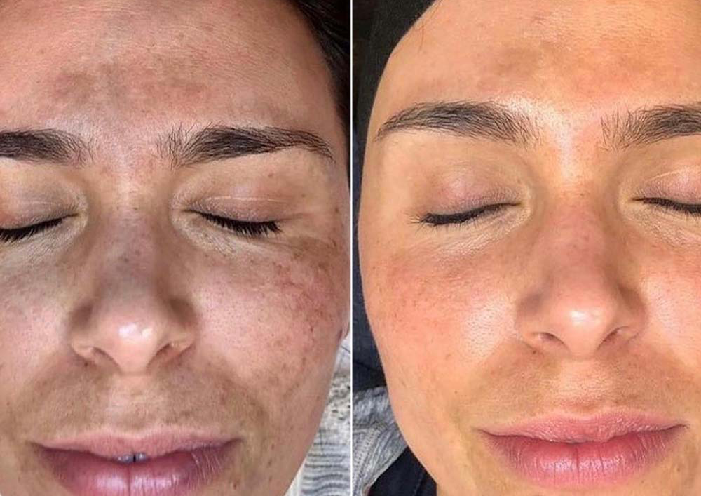 Chemical peel