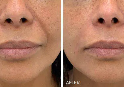 Nasolabial Filler 