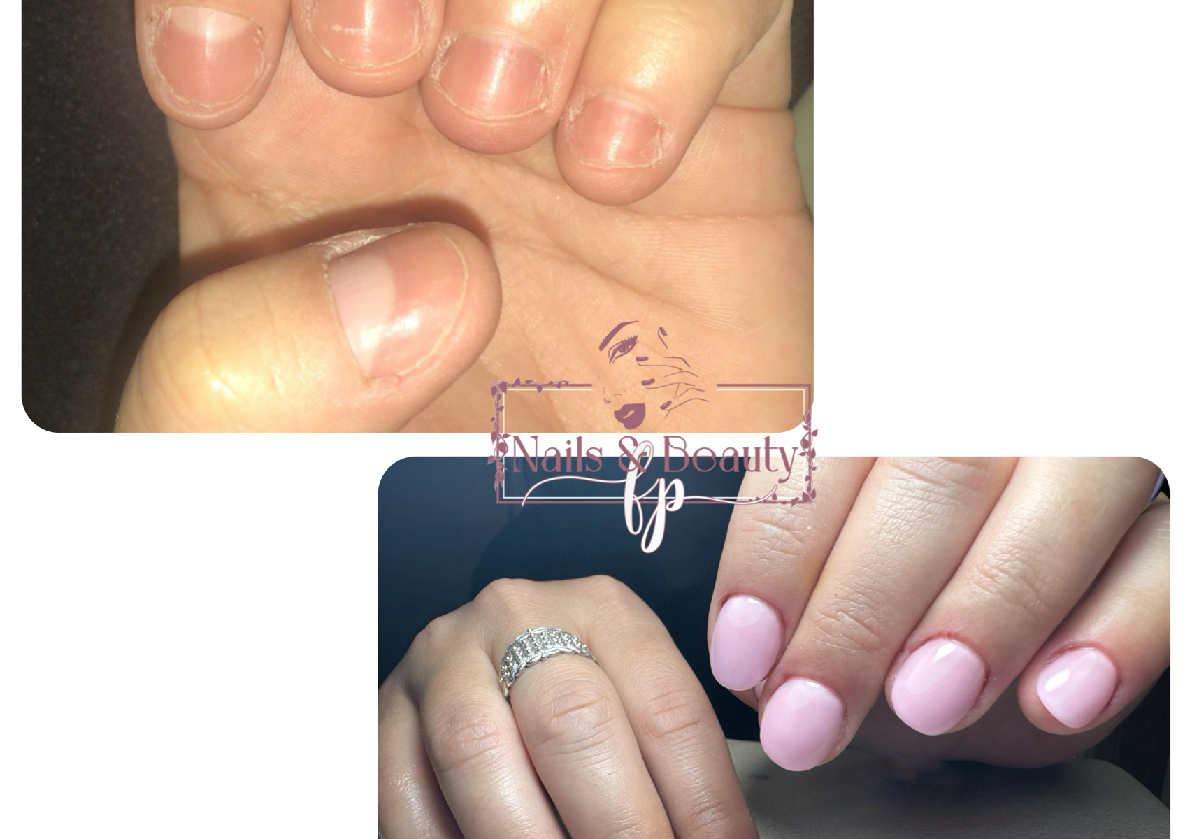 Ricostruzione onicofagia