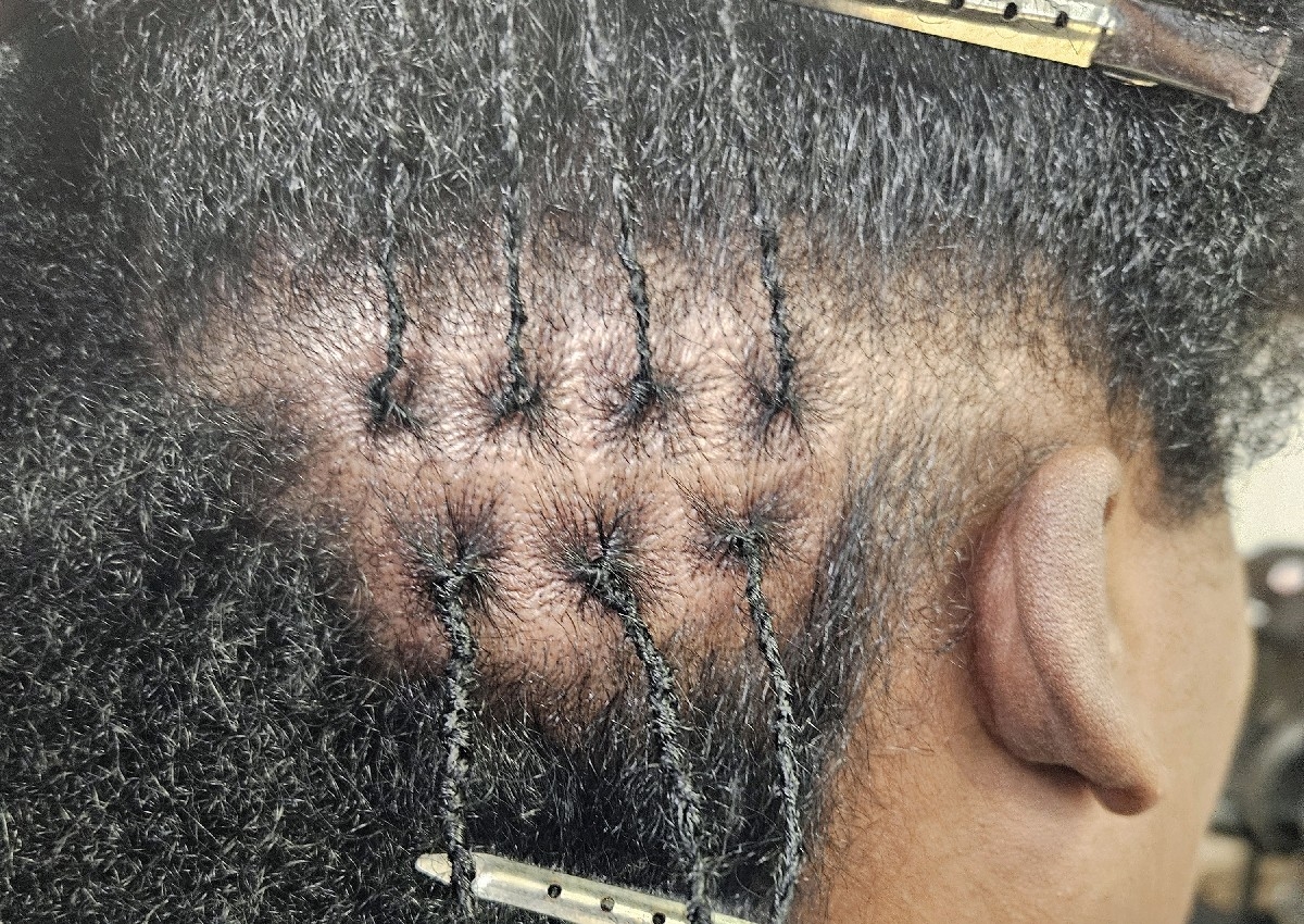 Microlocs/Interlocks Consultation