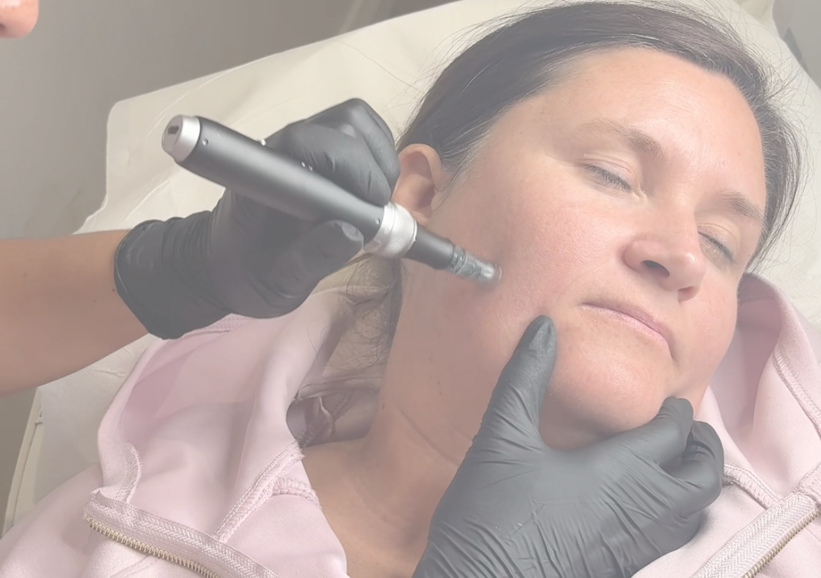 Microneedling