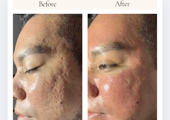 Procell Advanced Micro needling