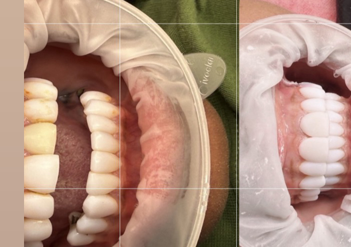 Mantenimiento de carillas 