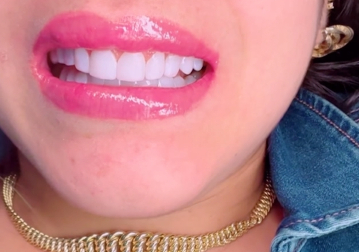  diseño de sonrisa  20 carillas ..  Smile design 20 veneers No puedes tener dientes de pocelana o coronas tendrias que reti