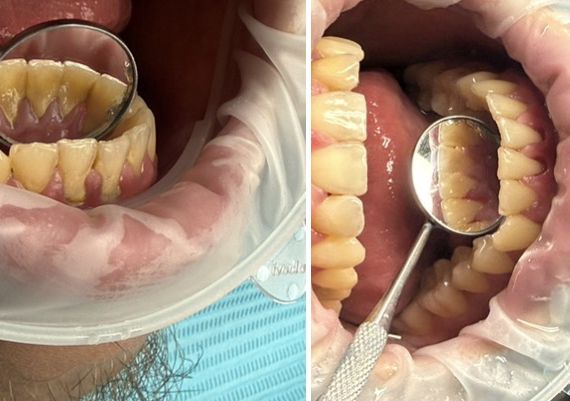 Limpieza profunda  .. Deep cleaning