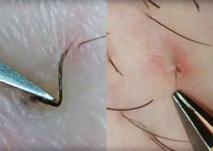 Ingrown Removal