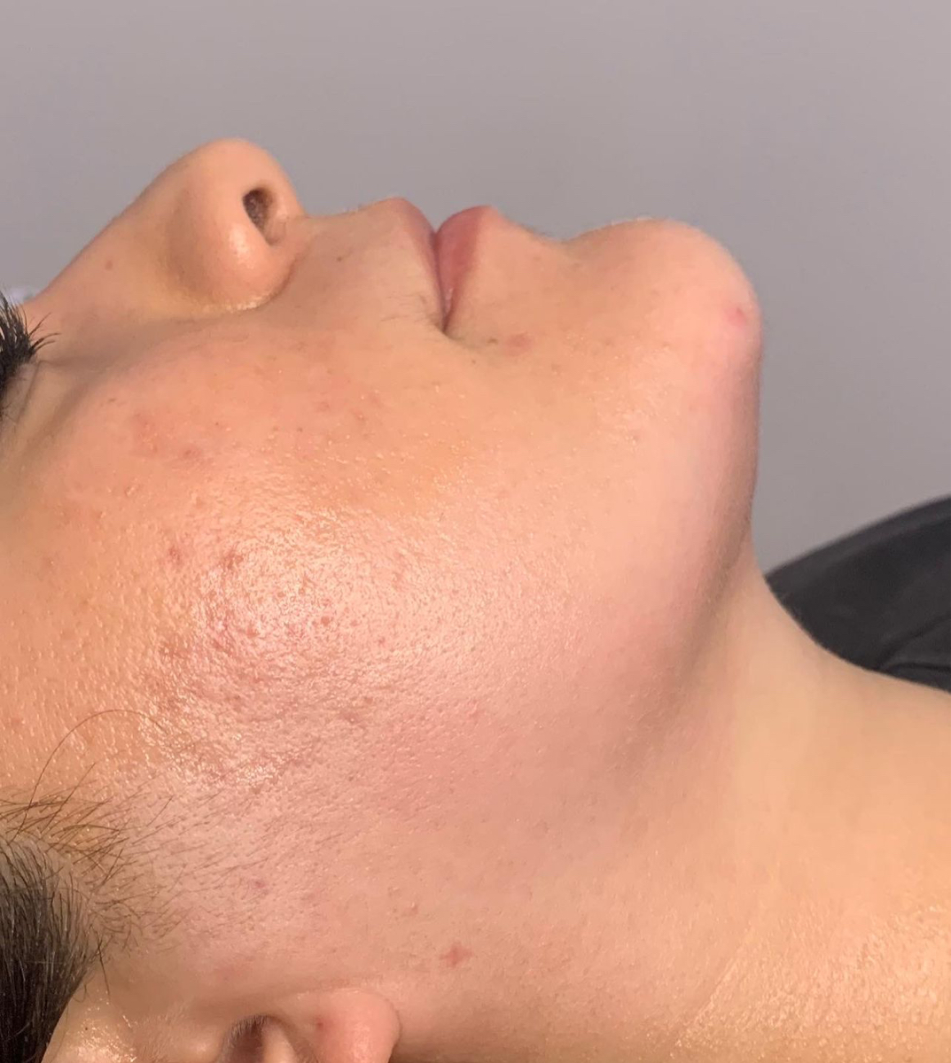 POST-OPERATORIO FACIAL ETAPA 2