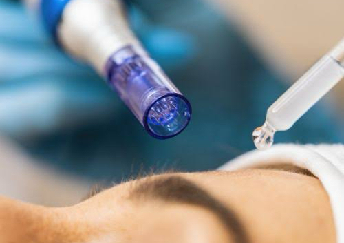 LIMPIEZA PROFUNDA Y DERMAPEN CON ACTIVOS 