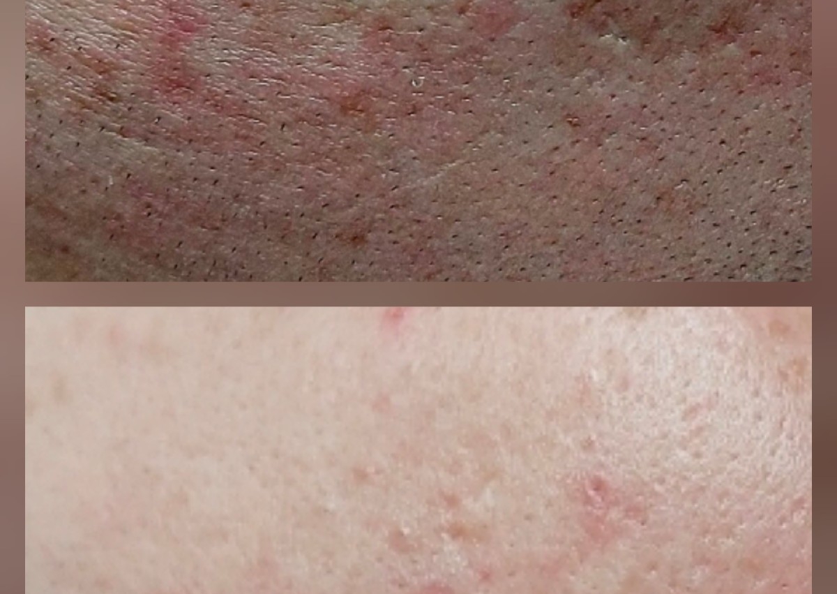 GF Needling with Growth Factors under Local Anesthetic
