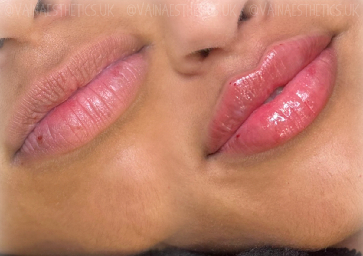 ✨ 0.8ml – Soft Balance Filler