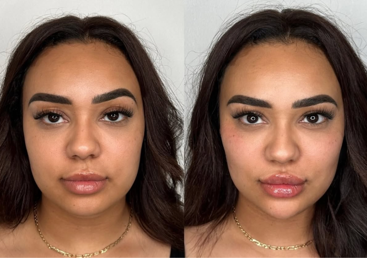 ✨ 5.5ml – Lower Face Rejuvenation