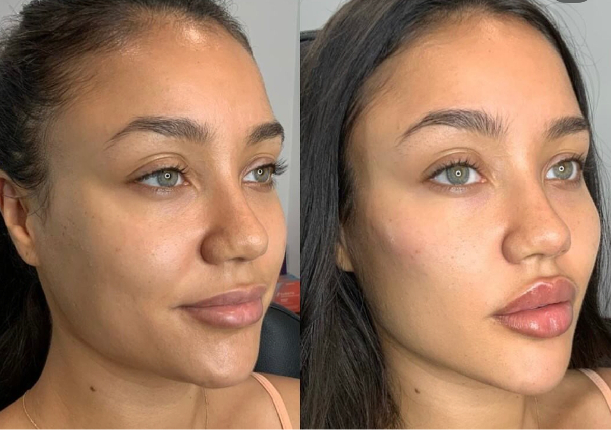 ✨ 4.4ml – Mid-Face Rejuvenation