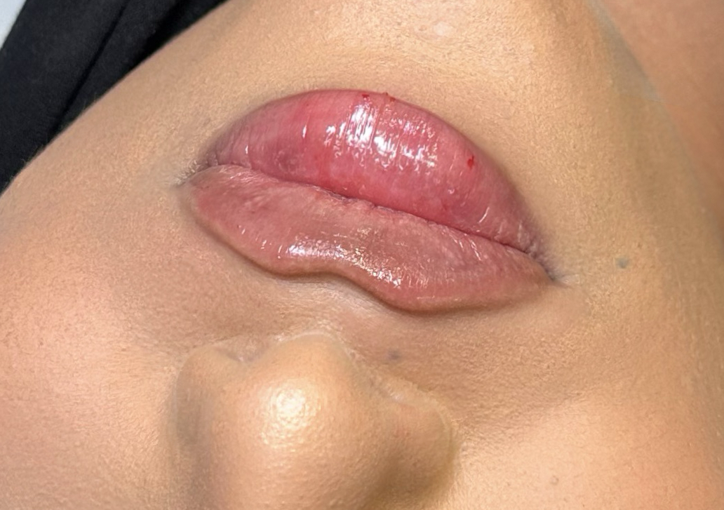 ✨ 1.1ml – Signature Enhancement Filler