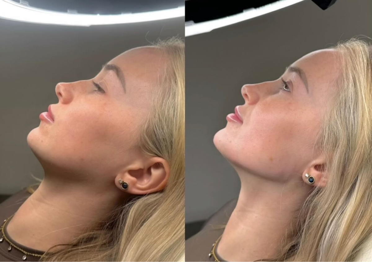 ✨ 3.3ml – Defined Jaw & Lower Face