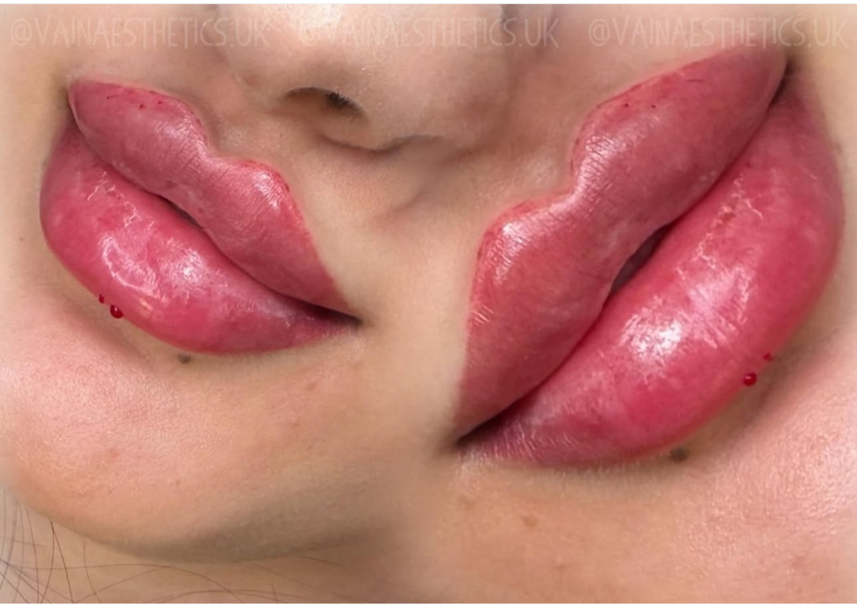 ✨ 1.5ml – Full & Defined Lips