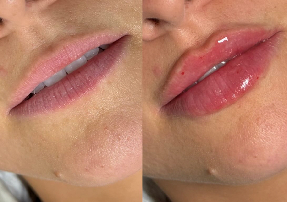 ✨ 0.5ml – Subtle Refresh Filler