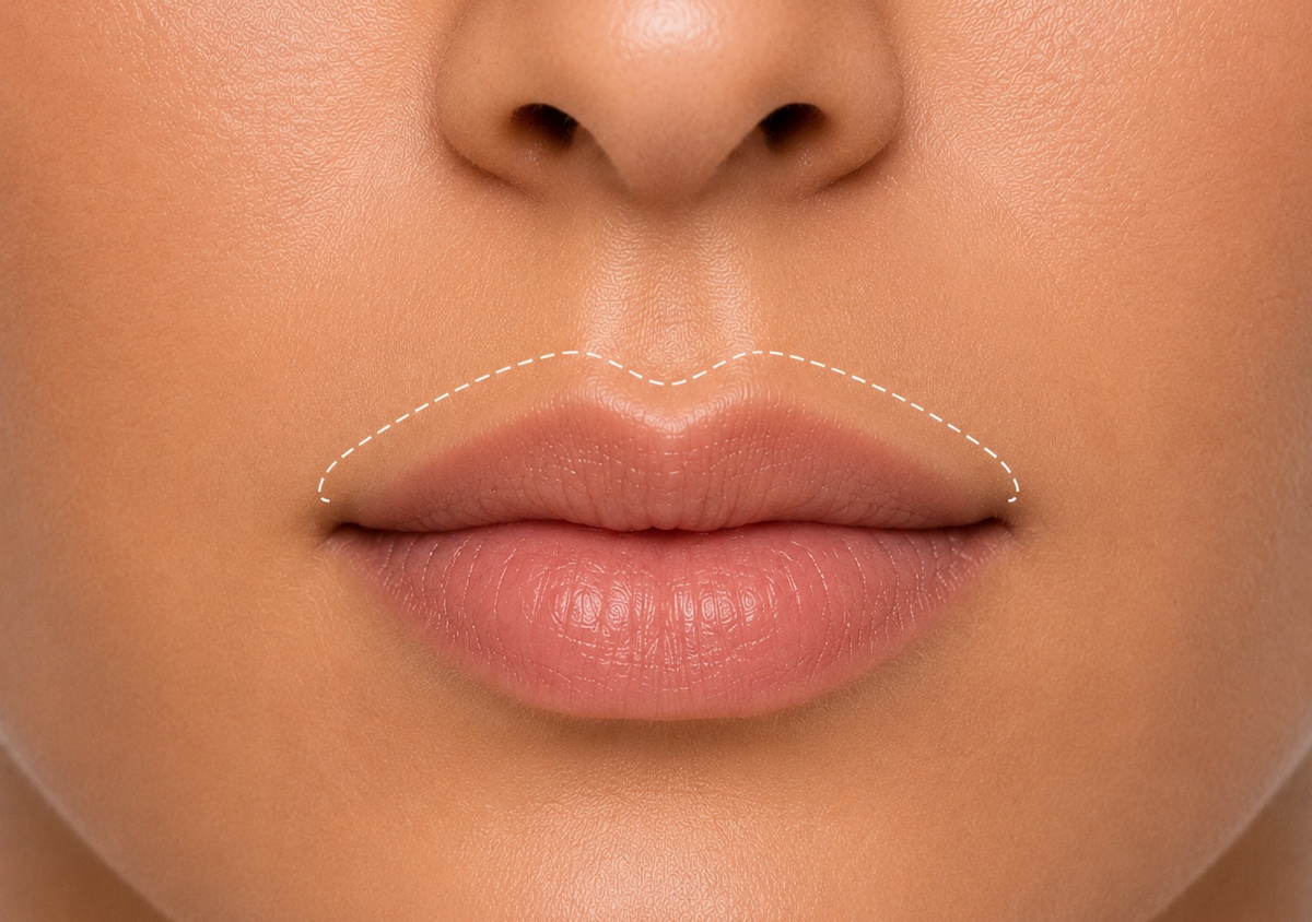 Upper Lip Precision Removal