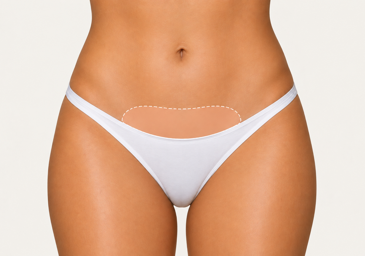 Mini Brazilian Sugar Removal