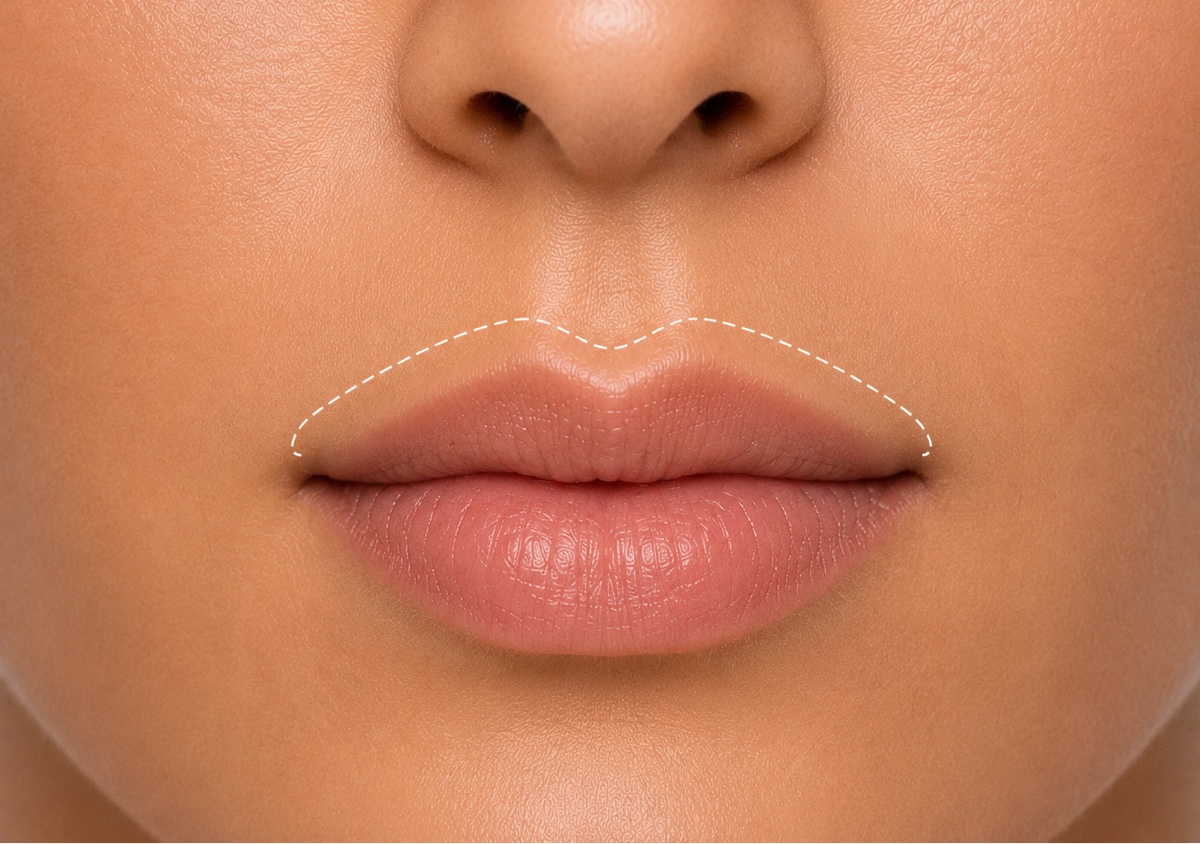 Upper Lip Sugar Removal