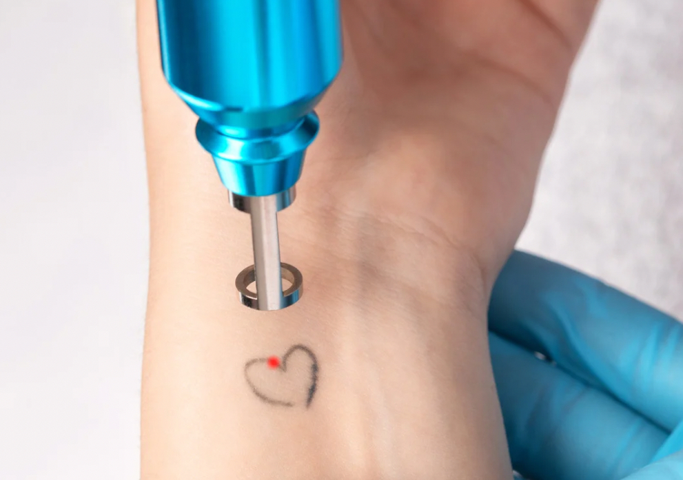 SKIN RENEWAL- ELIMINACIÓN DE TATUAJES CON LÁSER