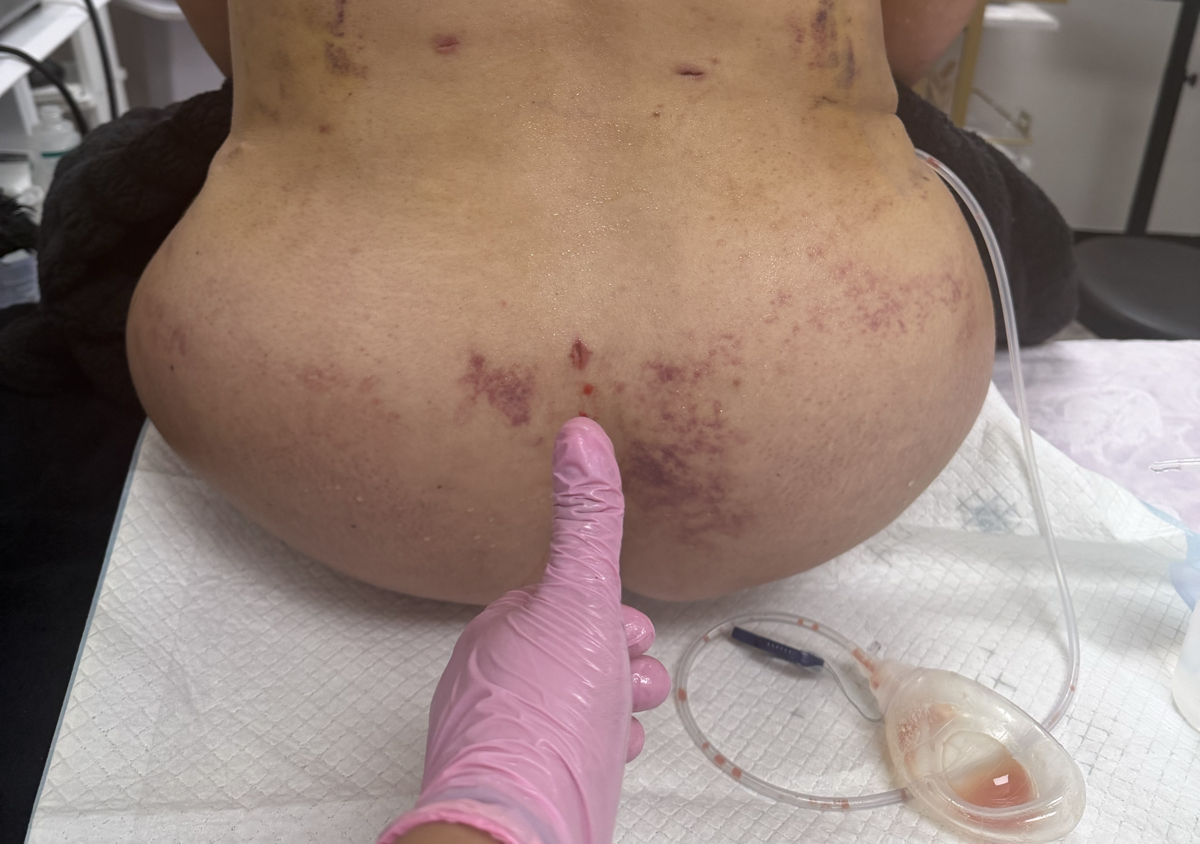 ✨ PAQUETE 10 SESIONES | POSTOPERATORIO💕