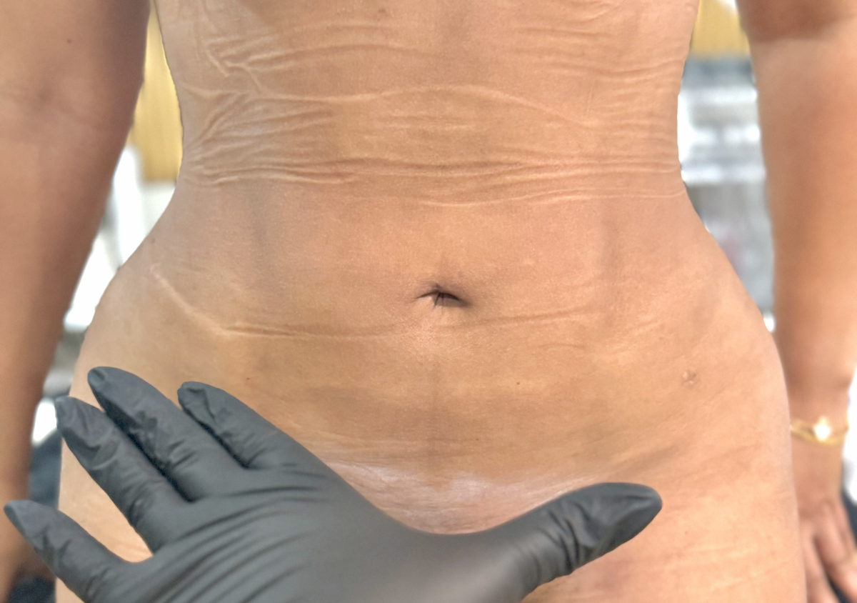 ✨SESIÓN INDIVIDUAL | DRENAJE POSTOPERATORIO💕