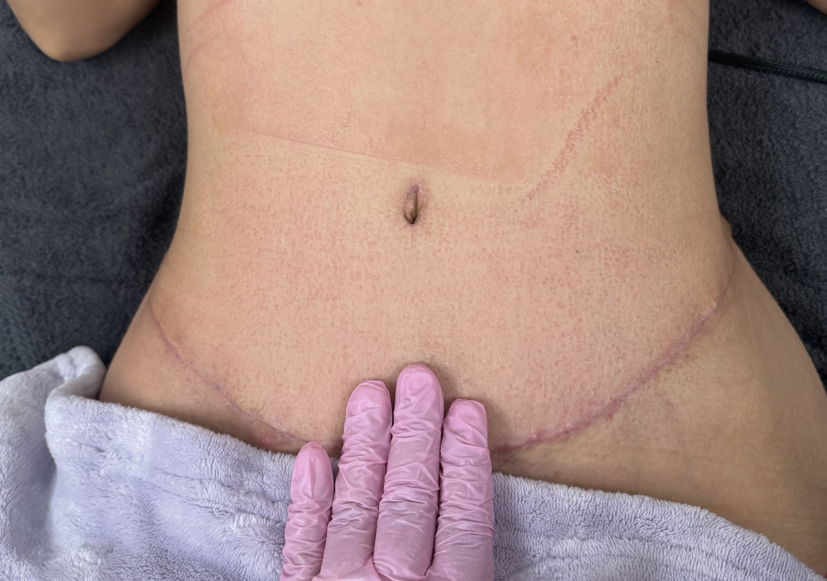 ✨ PAQUETE 5 SESIONES | POSTOPERATORIO💕