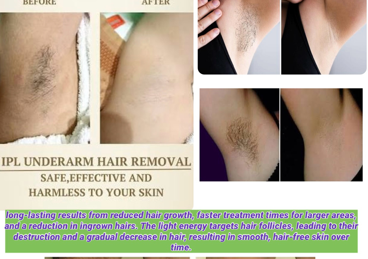 IPL hair removal treatment