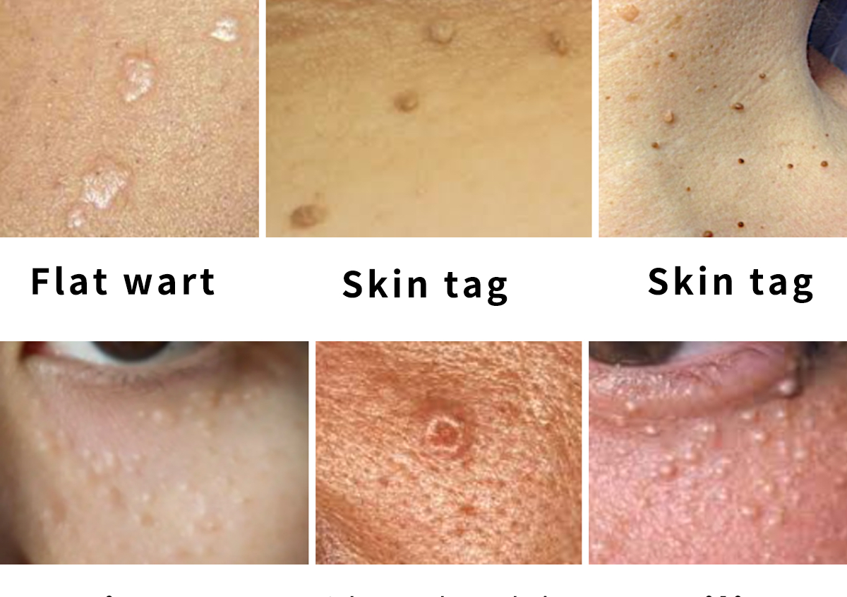 Warts/mole/milia removal(cautery)