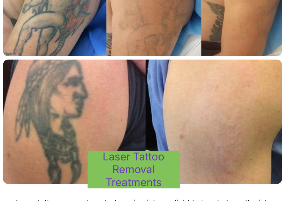 LaserTattoo removal  treatment