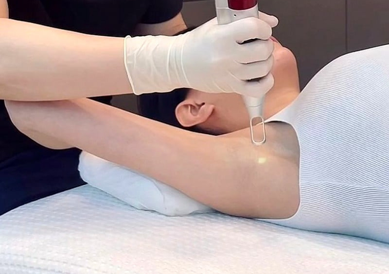 Underarms Whitening pico laser treatment