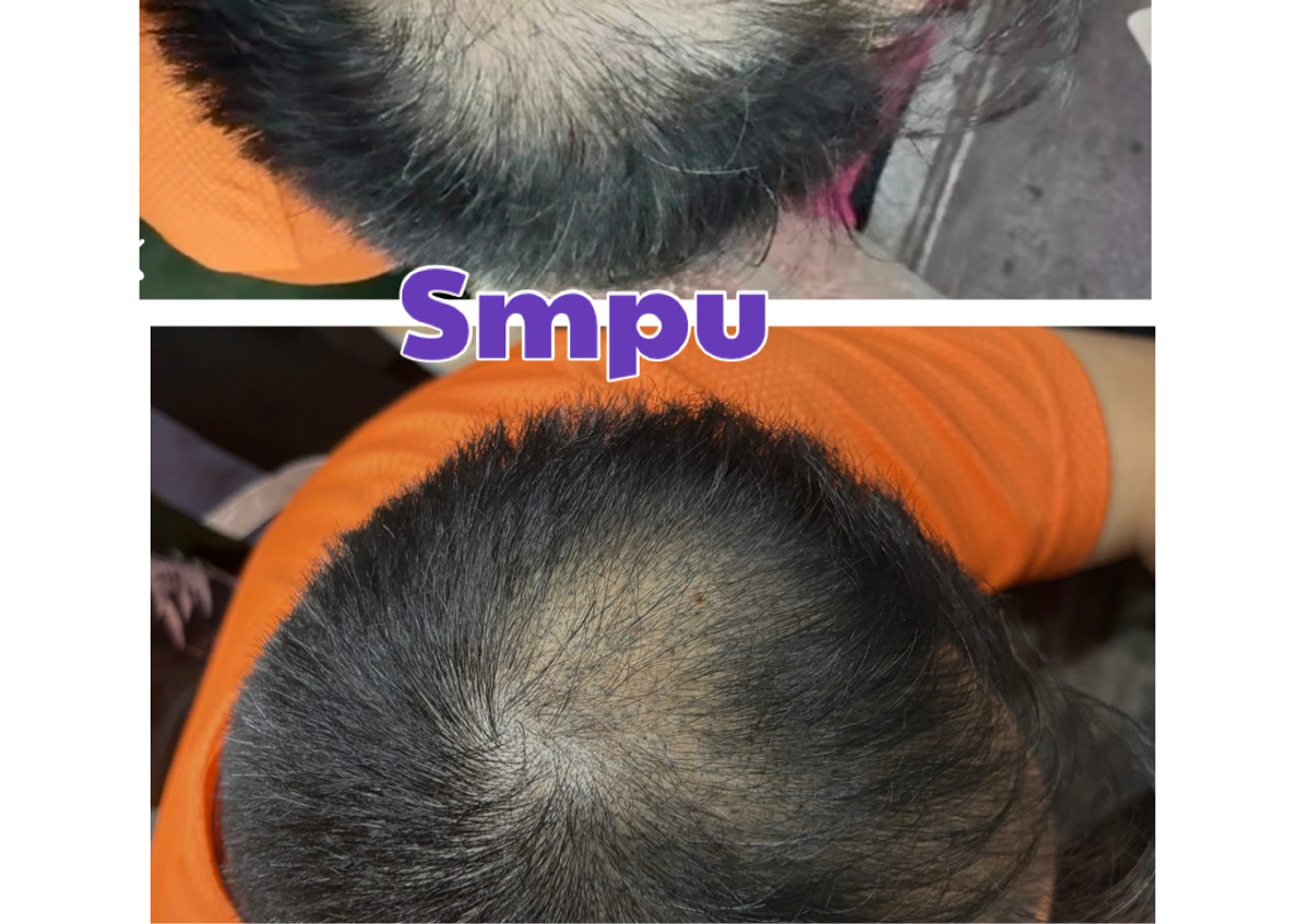 Scalp micro pigmentation
