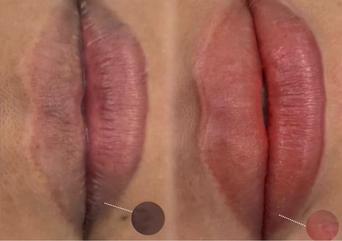 Neutralizacion + Lip Blush 💗