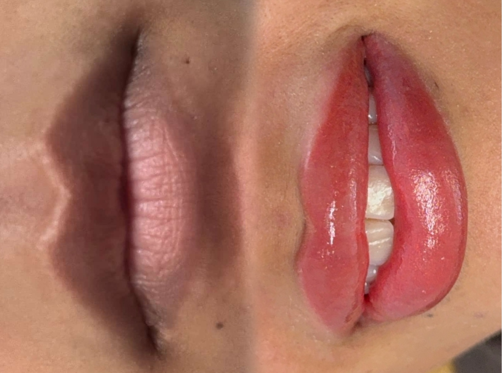 Neutralizacion + Lip Blush 