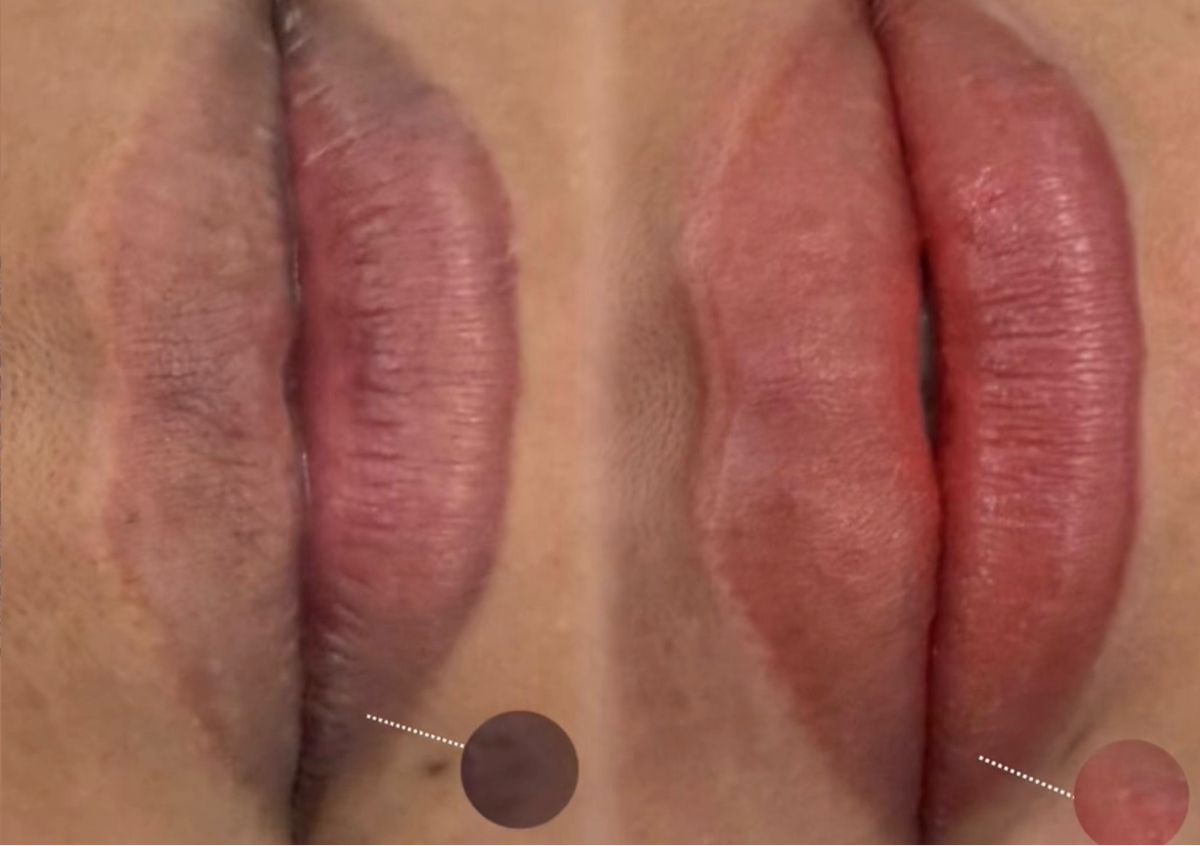 Retoque Lipblush + Neutralizacion 💗