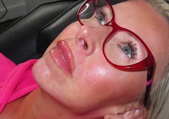 Jaw Line Filler