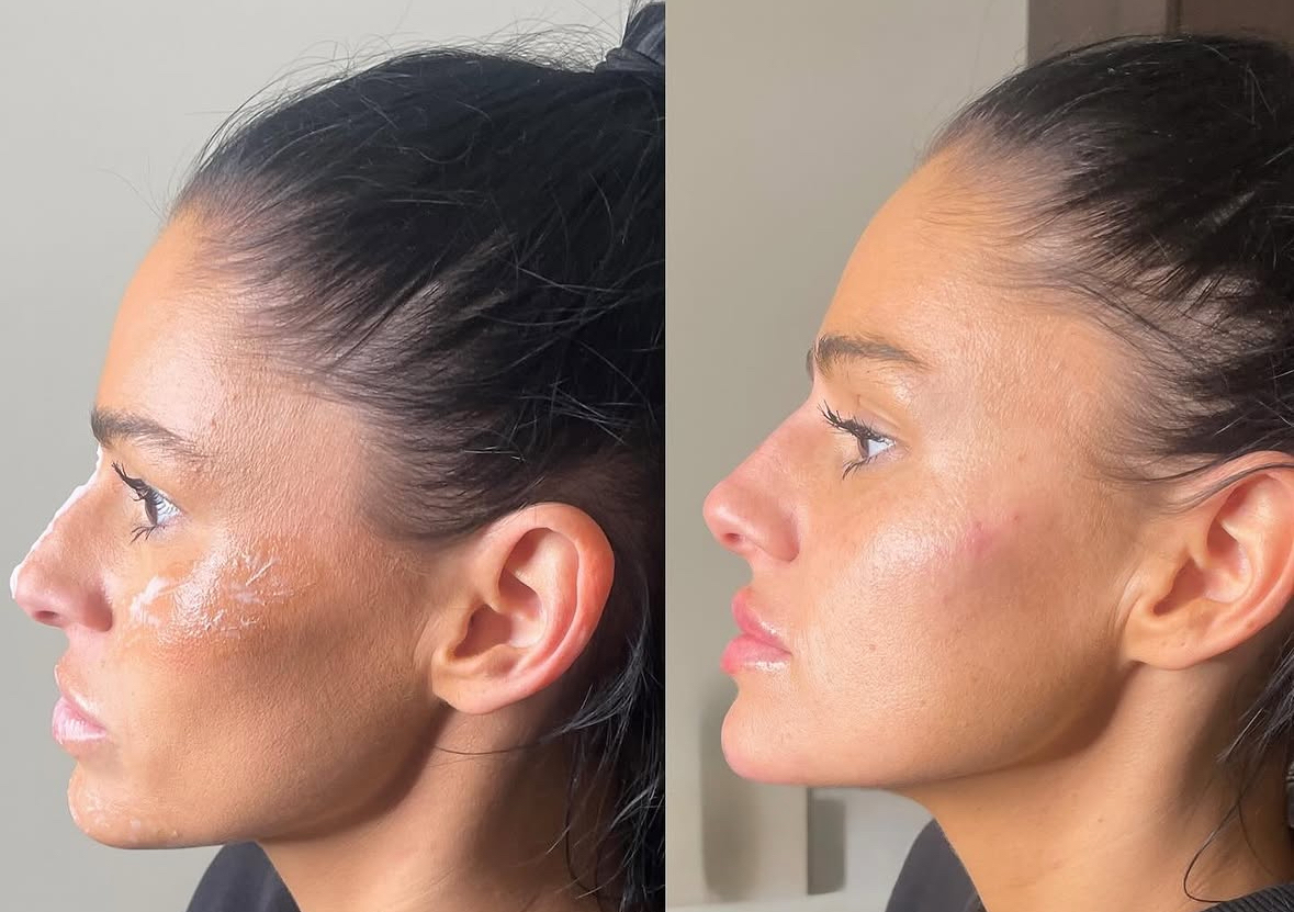 Chin Augmentation