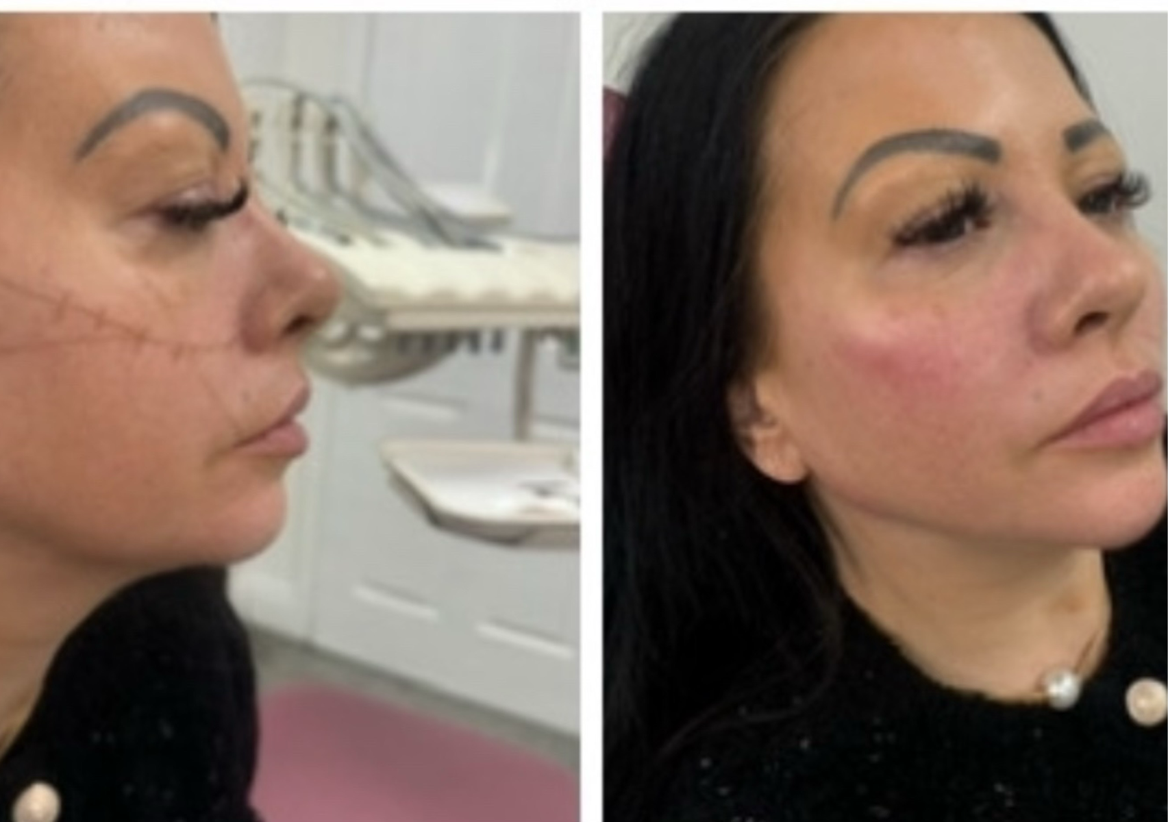 5ml face sculpting cheeks /chin/jawline