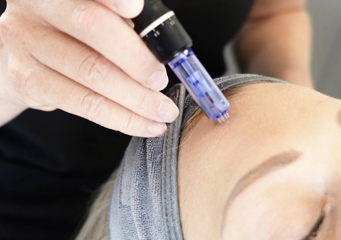 Microneedling exosomes+adn de saumon