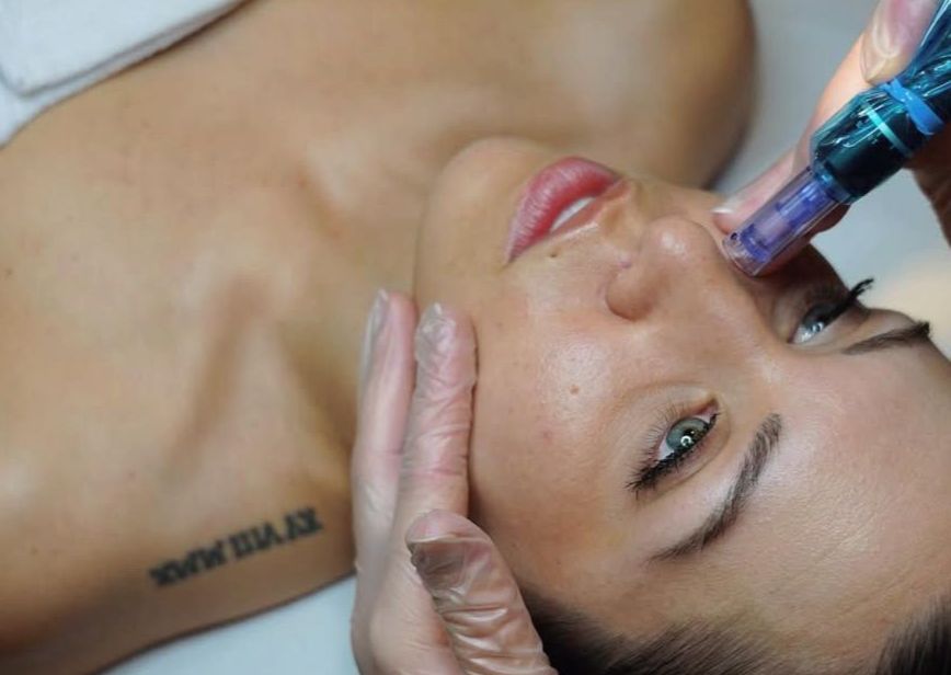 microneedling visage