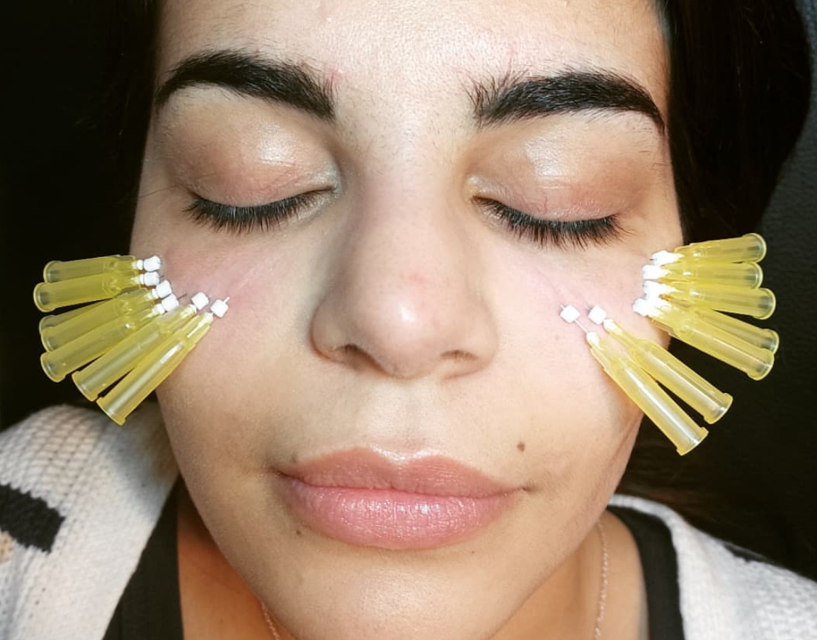 PDO Thread underEye Collagen Bulider